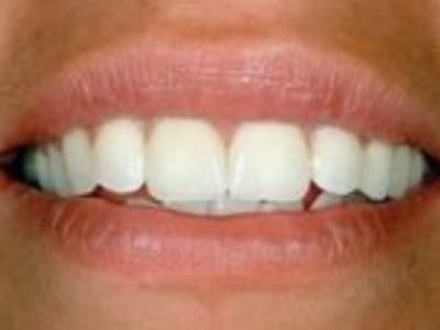 Close-up of a person's smile displaying bright, white, evenly-aligned teeth and healthy gums.