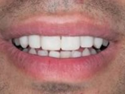 Close-up of a person's smile displaying white, straight teeth and healthy gums.