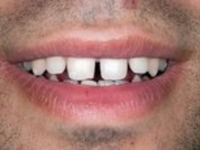 Close-up of smile showing dental gap between front teeth requiring orthodontic treatment.