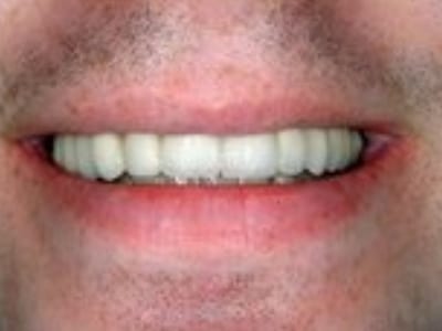 Close-up of a person's smile showing white, evenly aligned teeth and healthy gums.