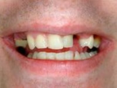 Close-up of a person's smile showing teeth with visible gaps and discoloration.