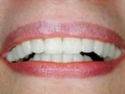 Close-up of a person's smile showing white teeth and natural lip color against skin tone.
