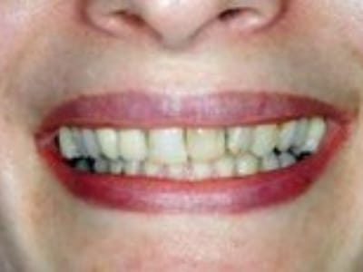 Close-up of person's smile showing teeth and gums in dental context.