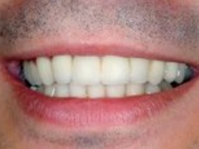 Close-up of a person's smile displaying bright, white teeth and healthy gums.