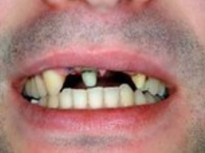 Close-up of open mouth showing damaged teeth with gaps and discoloration, dental care example.