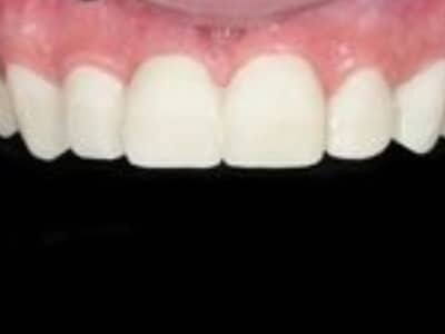 Close-up of white dental crowns on upper front teeth with pink gum tissue visible.