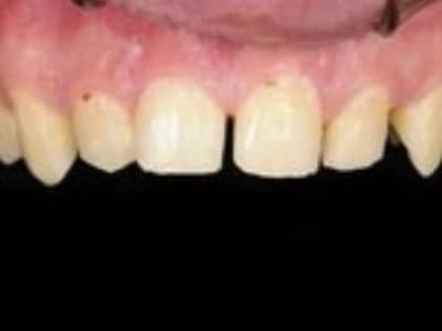 Close-up of upper front teeth showing spacing gap between central incisors and gum line.