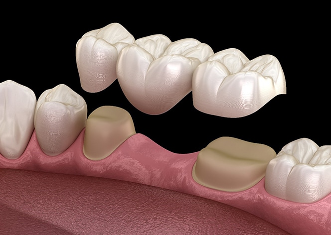 Dental bridge prosthetic restoration showing artificial teeth attached to gum model against black background.