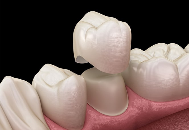 Dental Crowns in Tulsa