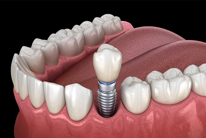 Dental Implants Tulsa OK
