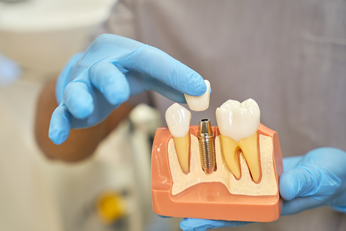 Dental implant model showing crown, abutment, and screw placement in jawbone.
